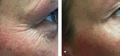 eyes before and after