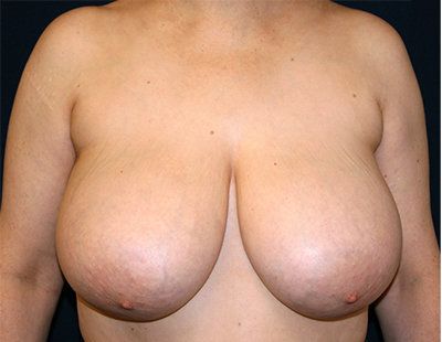Before breast reduction