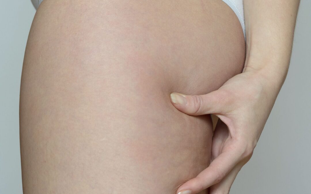 Safely and Effectively Improve Your Body Contours with SculpSure™