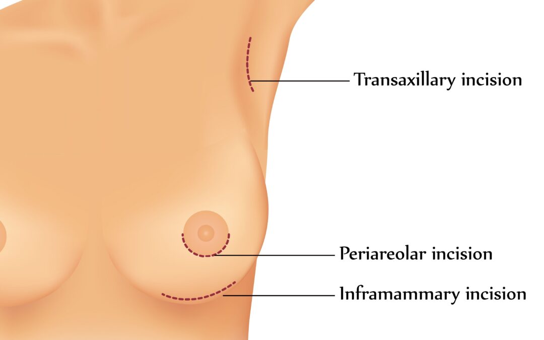 The Inframammary Breast Augmentation Incision Technique