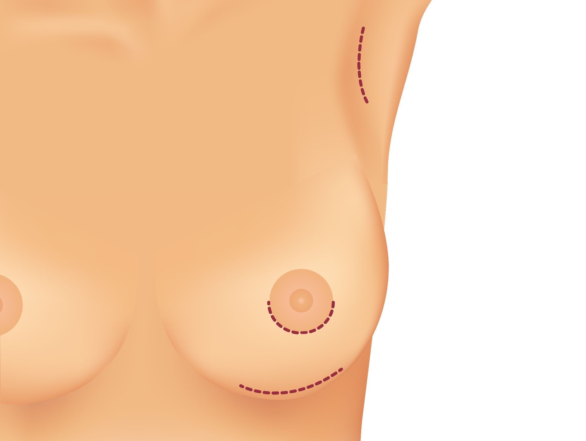 Different incision options for breast augmentation