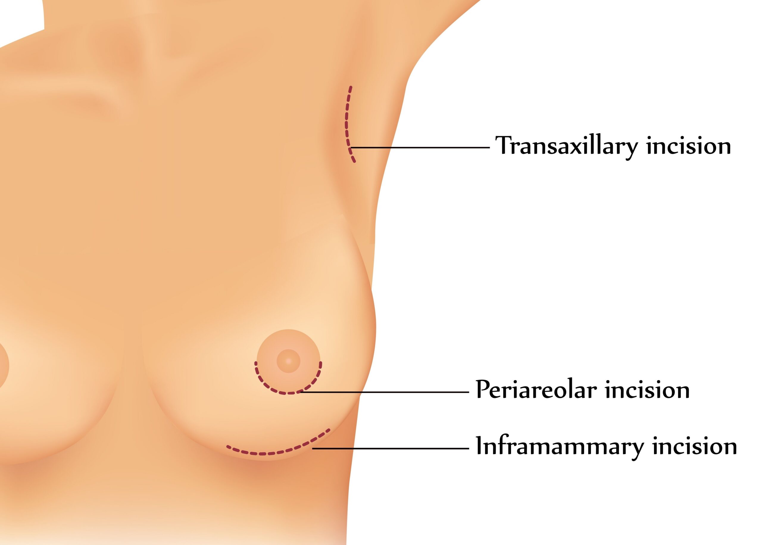 An illustration demonstrating three breast augmentation incision techniques, including the inframammary technique