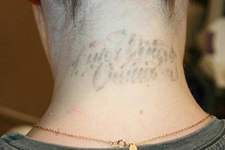 How to Prepare for and Recover From Tattoo Removal