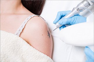 5 Ways to Speed Up the Tattoo Removal Process