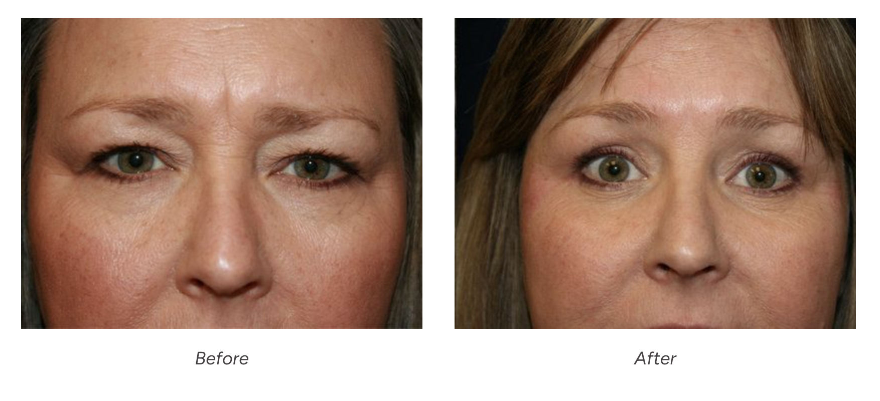 Blepharoplasty – Reno, Lake Tahoe – Eyelid Surgery – Eye Lift