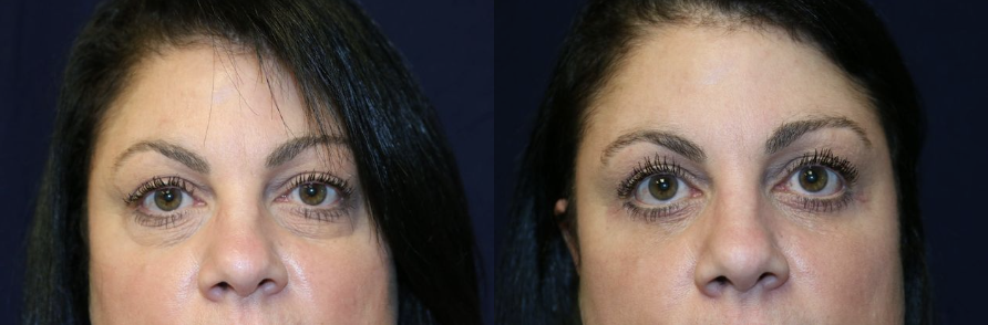 Eye Lift Before & After Gallery