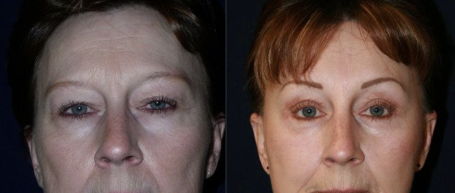 Eye Lift Before & After Gallery
