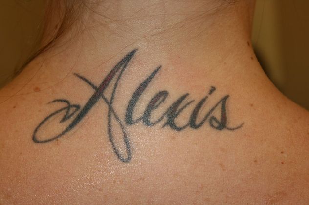 Laser Tattoo Removal Reno, NV – Lake Tahoe, NV – Murphy Plastic Surgery & Medical Spa