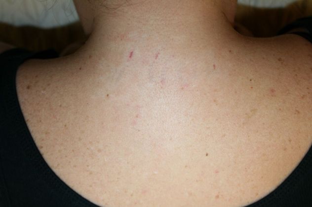 Laser Tattoo Removal Reno, NV – Lake Tahoe, NV – Murphy Plastic Surgery & Medical Spa