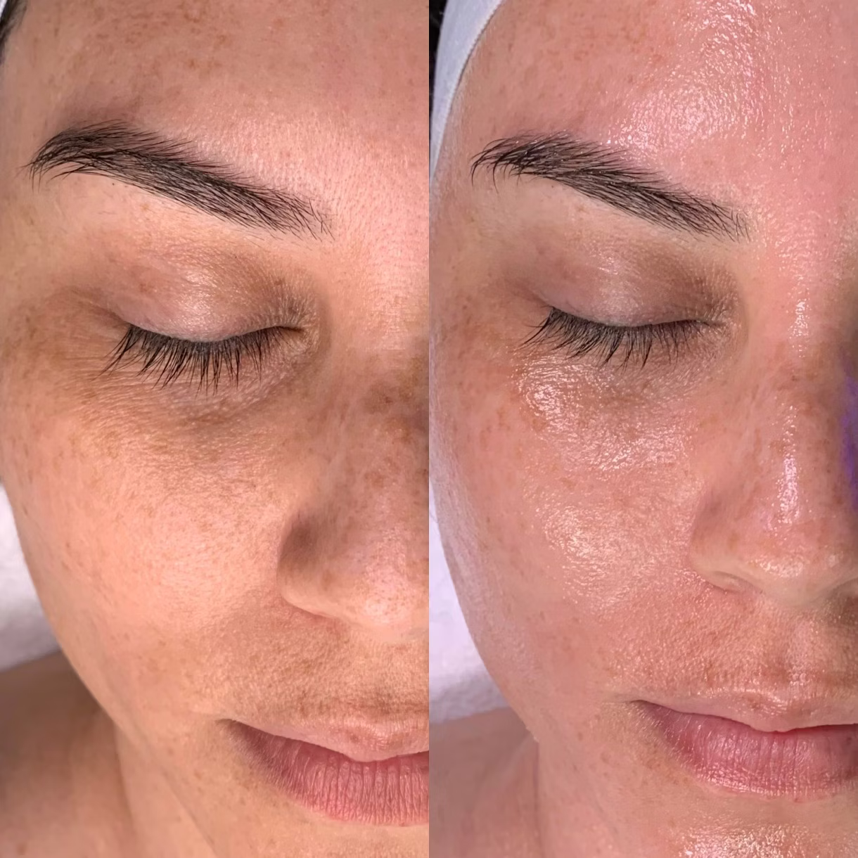 Hydrafacial Reno, NV – Lake Tahoe, NV – Murphy Plastic Surgery & Medical Spa