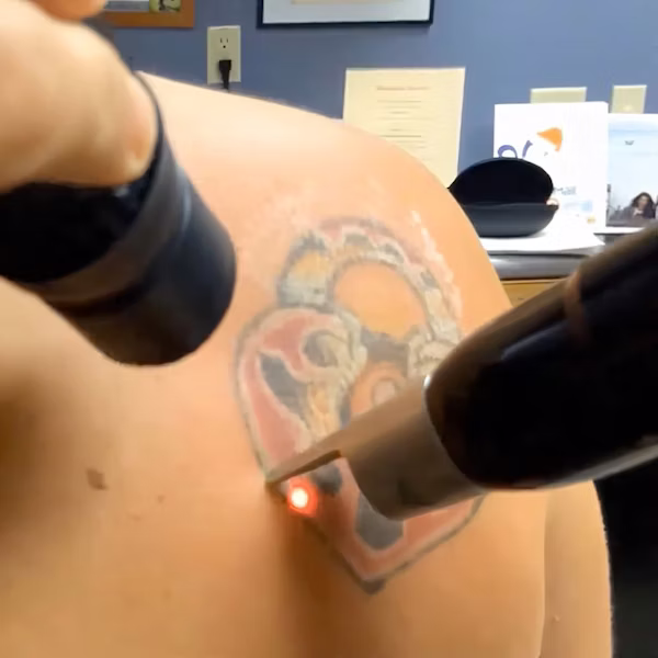 Laser Tattoo Removal Reno, NV – Lake Tahoe, NV – Murphy Plastic Surgery & Medical Spa