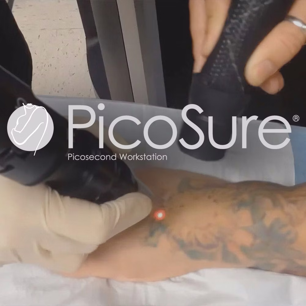 Laser Tattoo Removal Reno, NV – Lake Tahoe, NV – Murphy Plastic Surgery & Medical Spa