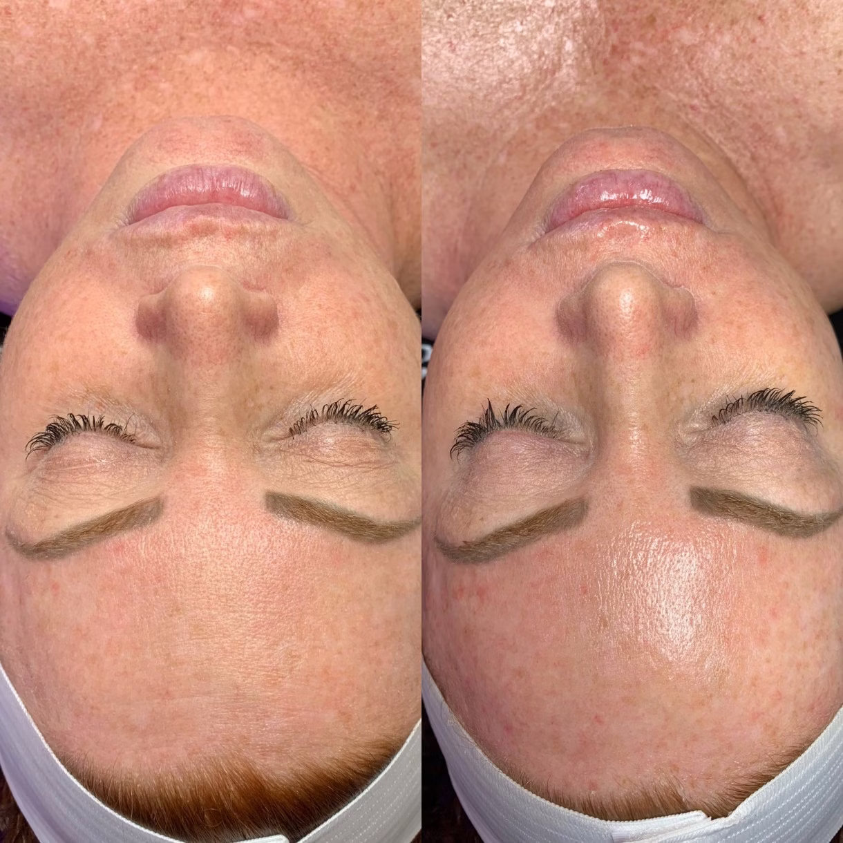 Hydrafacial Reno, NV – Lake Tahoe, NV – Murphy Plastic Surgery & Medical Spa