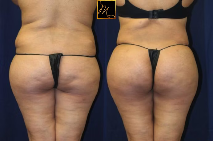 Brazilian Butt Lift Reno, NV – Lake Tahoe, NV – Murphy Plastic Surgery & Medical Spa