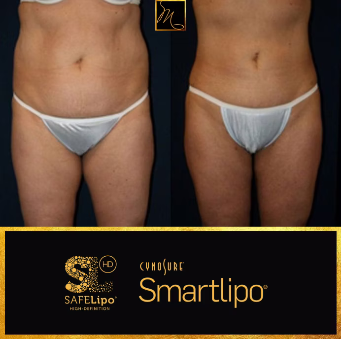 Liposuction in Reno, NV | Murphy Plastic Surgery