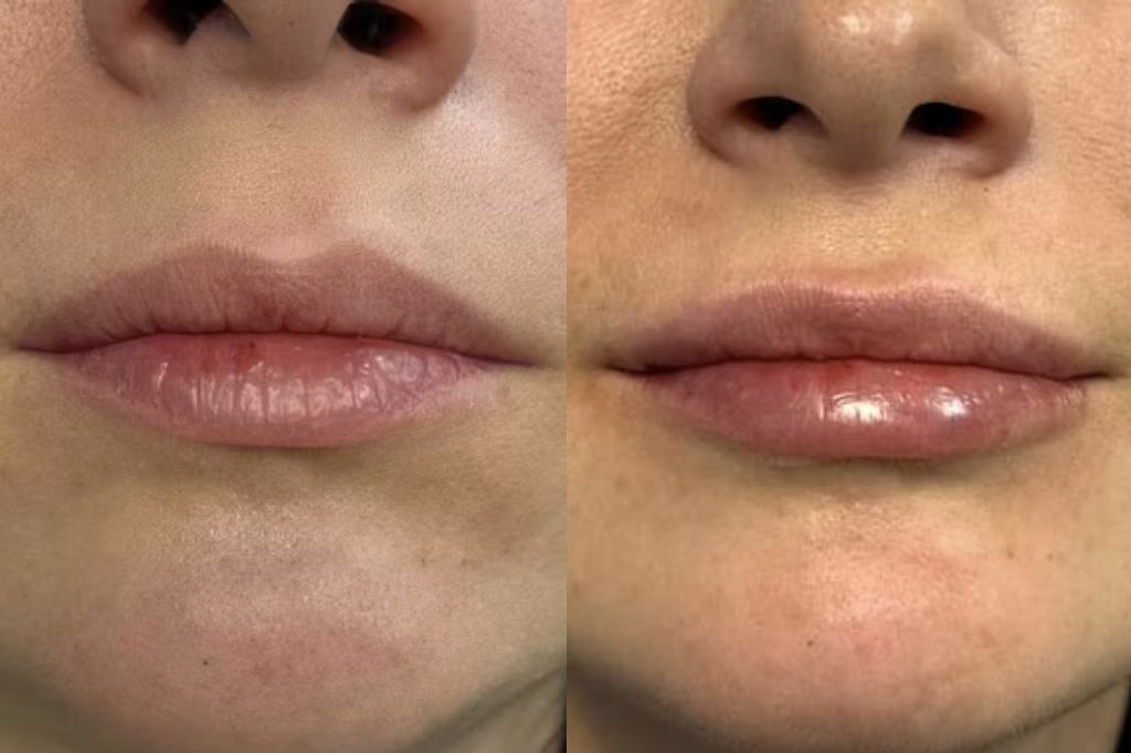 Injectables Reno, NV – Lake Tahoe, NV – Murphy Plastic Surgery & Medical Spa