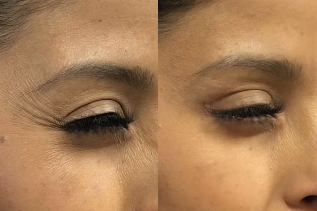 Injectables Reno, NV – Lake Tahoe, NV – Murphy Plastic Surgery & Medical Spa