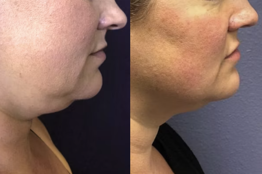 Injectables Reno, NV – Lake Tahoe, NV – Murphy Plastic Surgery & Medical Spa