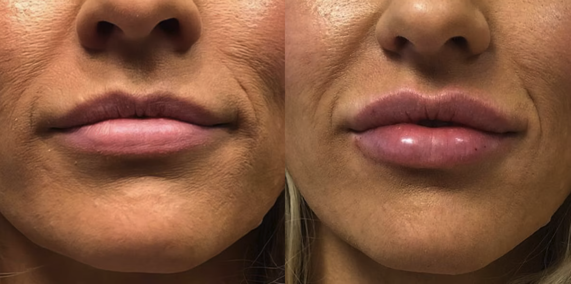 Juvederm Reno, NV – Lake Tahoe, NV – Murphy Plastic Surgery & Medical Spa