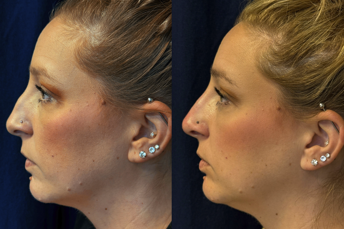 Juvederm Reno, NV – Lake Tahoe, NV – Murphy Plastic Surgery & Medical Spa