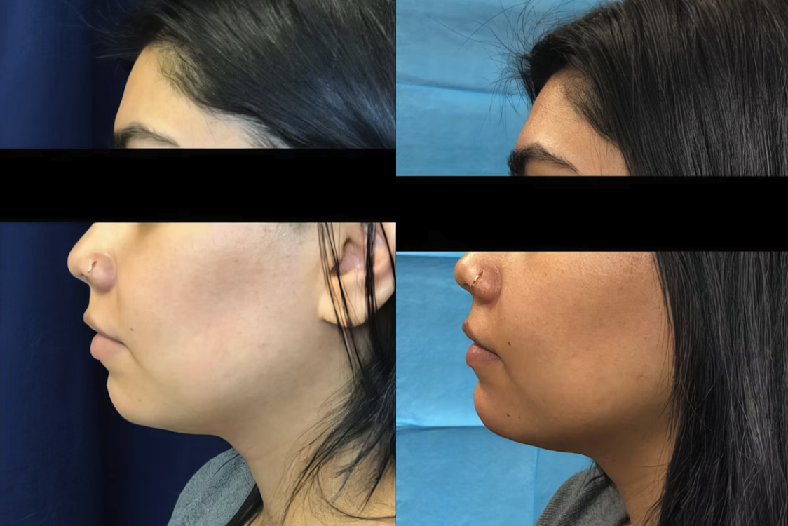 Juvederm Reno, NV – Lake Tahoe, NV – Murphy Plastic Surgery & Medical Spa