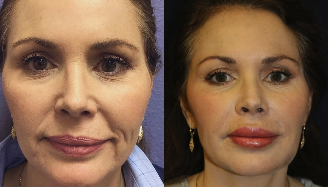Juvederm Reno, NV – Lake Tahoe, NV – Murphy Plastic Surgery & Medical Spa