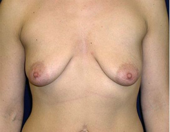 Breast Lift With Augmentation*: Case 1 - Front Before