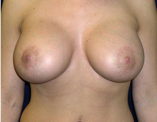 Breast Lift With Augmentation*: Case 1 - Front After