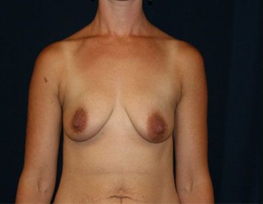 Breast Lift With Augmentation*: Case 2 - Front Before