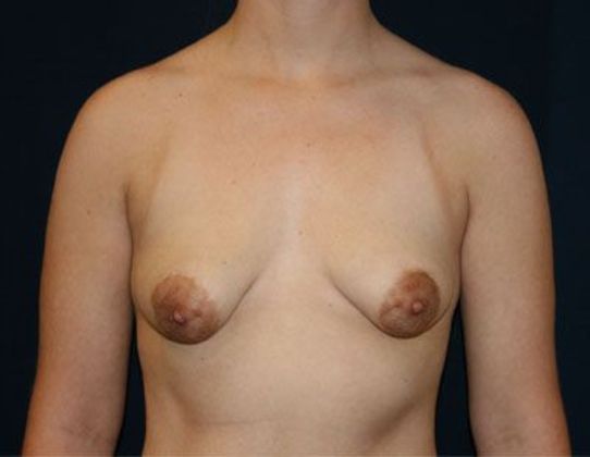 Breast Lift With Augmentation*: Case 3 - Front Before