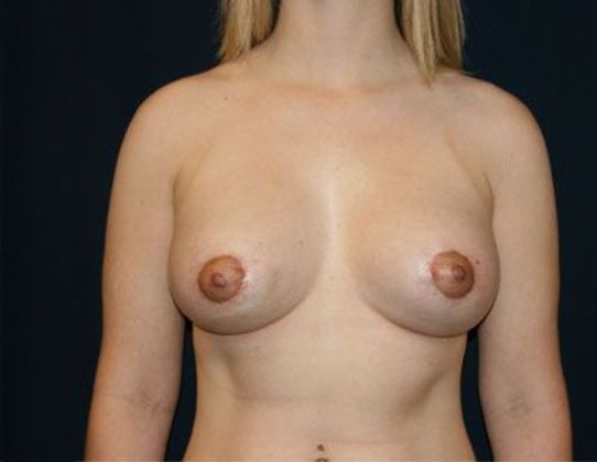 Breast Lift With Augmentation*: Case 3 - Front After