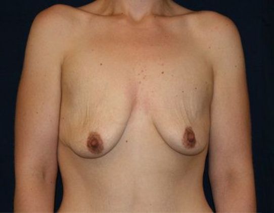 Breast Lift With Augmentation*: Case 7 - Front Before