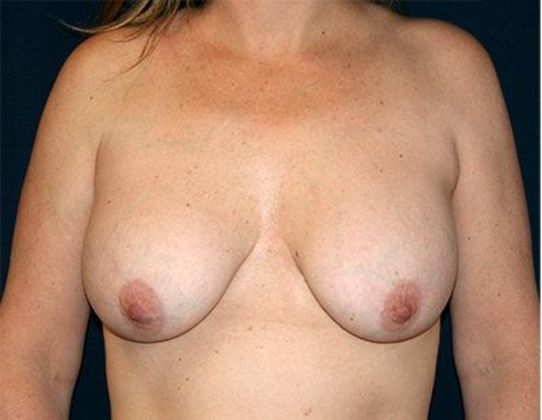 Breast Lift With Augmentation*: Case 12 - Front Before