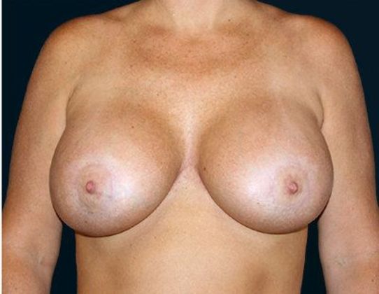 Breast Lift With Augmentation*: Case 12 - Front After