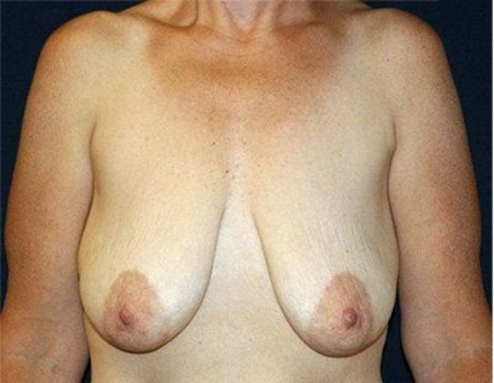 Breast Lift With Augmentation*: Case 23 - Front Before