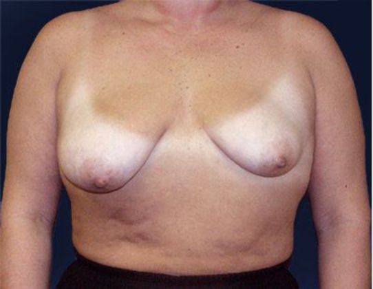Breast Lift With Augmentation*: Case 27 - Front Before