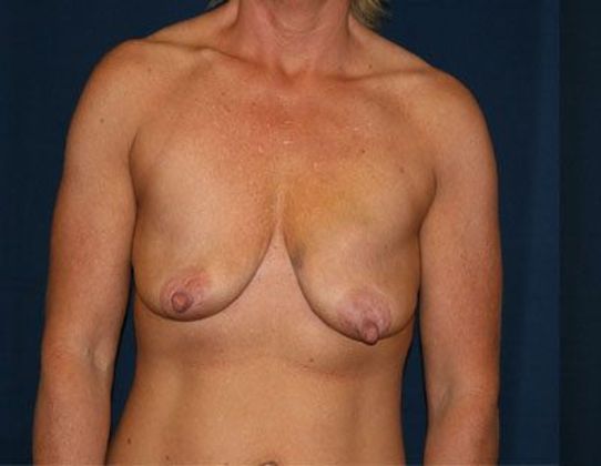 Breast Lift With Augmentation*: Case 31 - Front Before