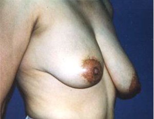 Breast Reduction*: Case 4 - Side Before
