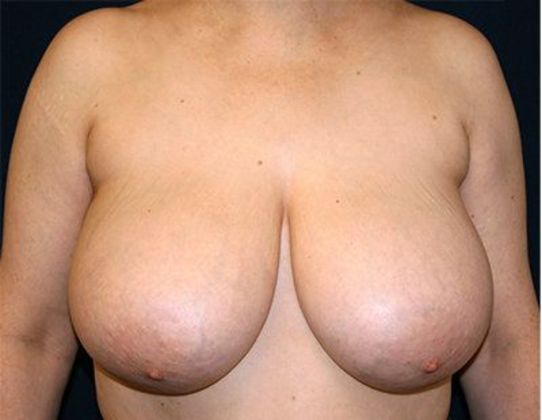 Breast Reduction*: Case 6 - Front Before