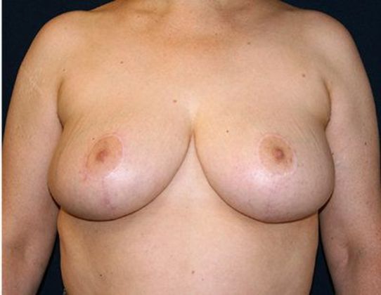 Breast Reduction*: Case 6 - Front After