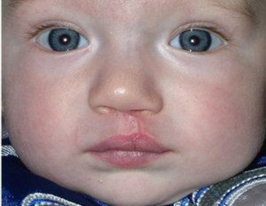 Cleft Lip*: Case 4 - After