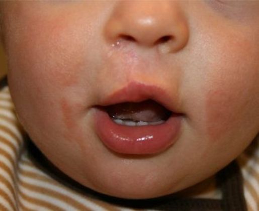 Cleft Lip*: Case 6 - After