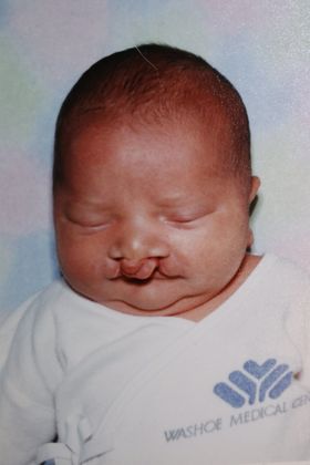 Cleft Lip* Case 8 - Before