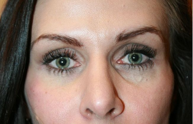 Cosmetic Injectables & Fillers*: Case 34 Undereye Filler - Before Restylane Treatment to tear troughs