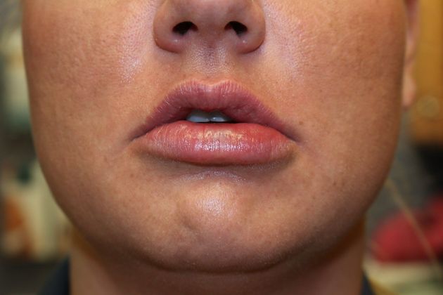 Cosmetic Injectables & Fillers*: Case 16 Lip Filler - After correction to lips.