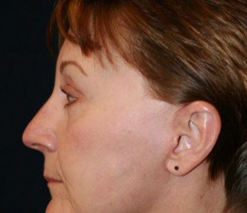 Eye Lift*: Case 2 - Side After