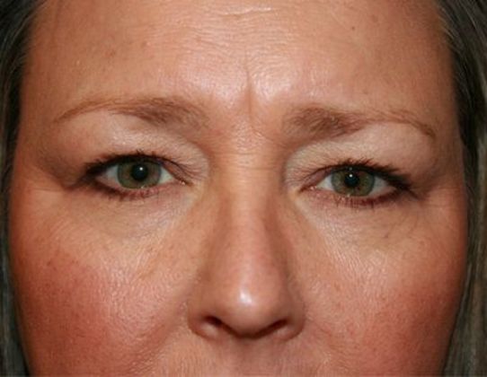 Eye Lift*: Case 3 - Before