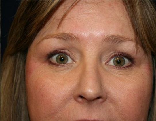 Eye Lift*: Case 3 - After