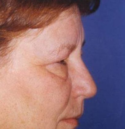 Eye Lift*: Case 4 - Side Before