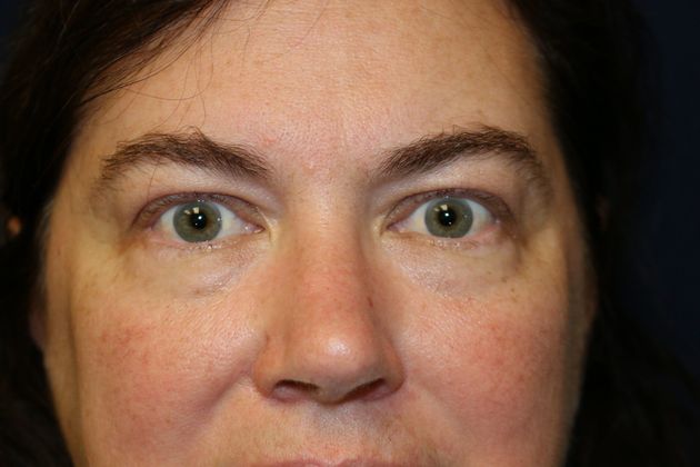 Eye Lift*: Case 6 - Before